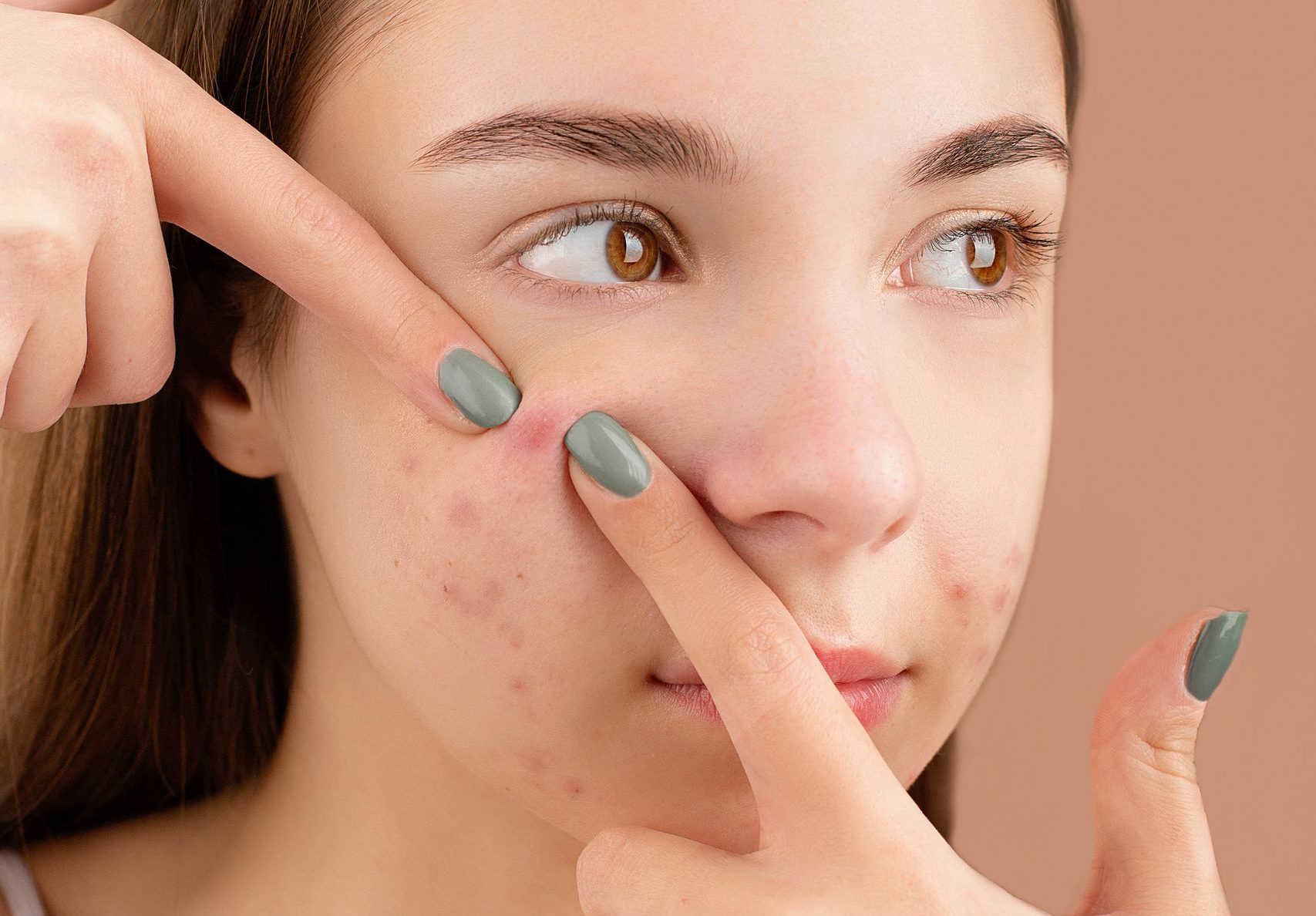 A young woman with acne pricking her face in a studio shoot.